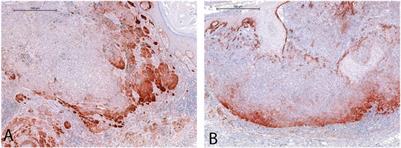 G protein-coupled estrogen receptor 1 and collagen XVII endodomain expression in human cutaneous melanomas: can they serve as prognostic factors?